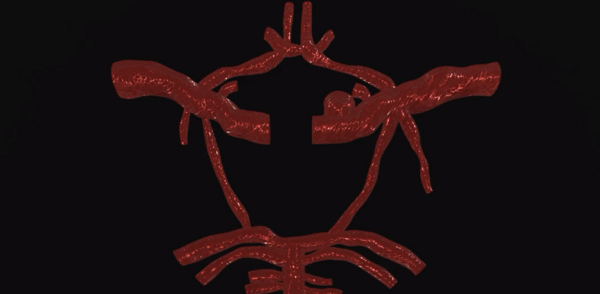 aneurysm brain