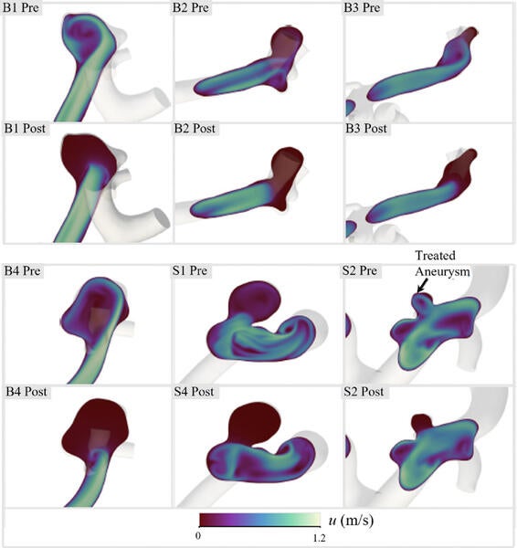 cfd aneurysm